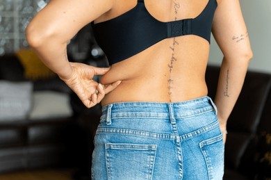 expert post weight loss surgery in Dubai